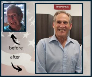 A Veteran showing what he looked like before when he was missing several teeth, and afterwards when he got care through Adopt a Vet Dental.
